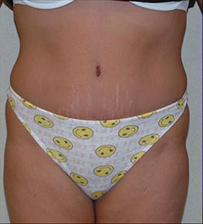 Tummy Tuck Before & After Gallery - Patient 122054812 - Image 2