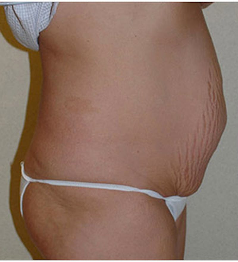 Tummy Tuck Before & After Gallery - Patient 122054812 - Image 3