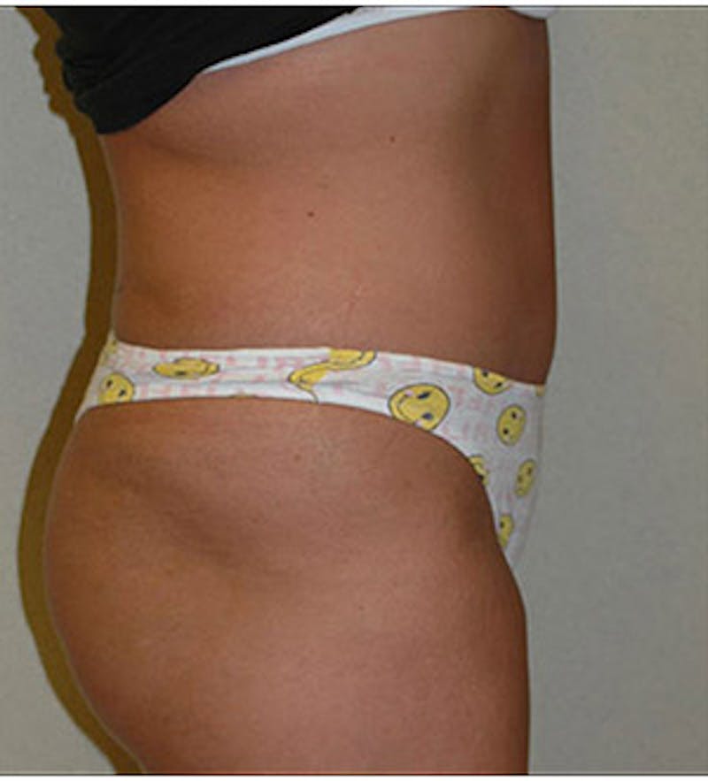 Tummy Tuck Before & After Gallery - Patient 122054812 - Image 4