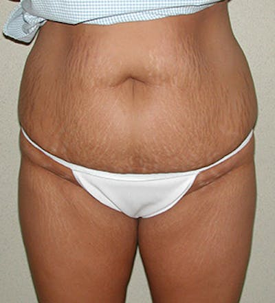 Tummy Tuck Before & After Gallery - Patient 122054813 - Image 1