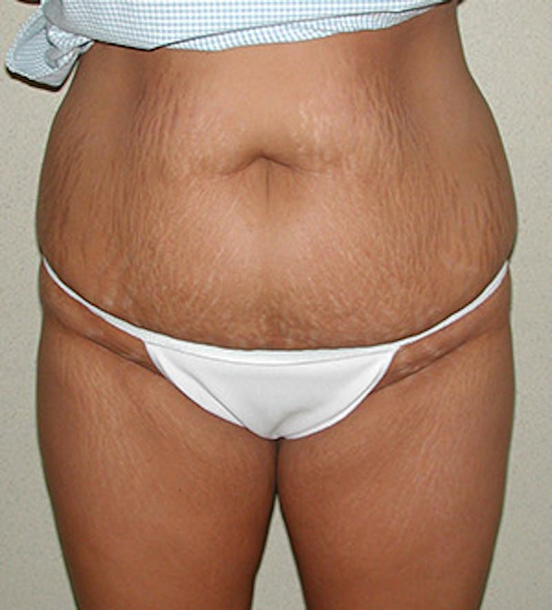 Tummy Tuck Before & After Gallery - Patient 122054813 - Image 1