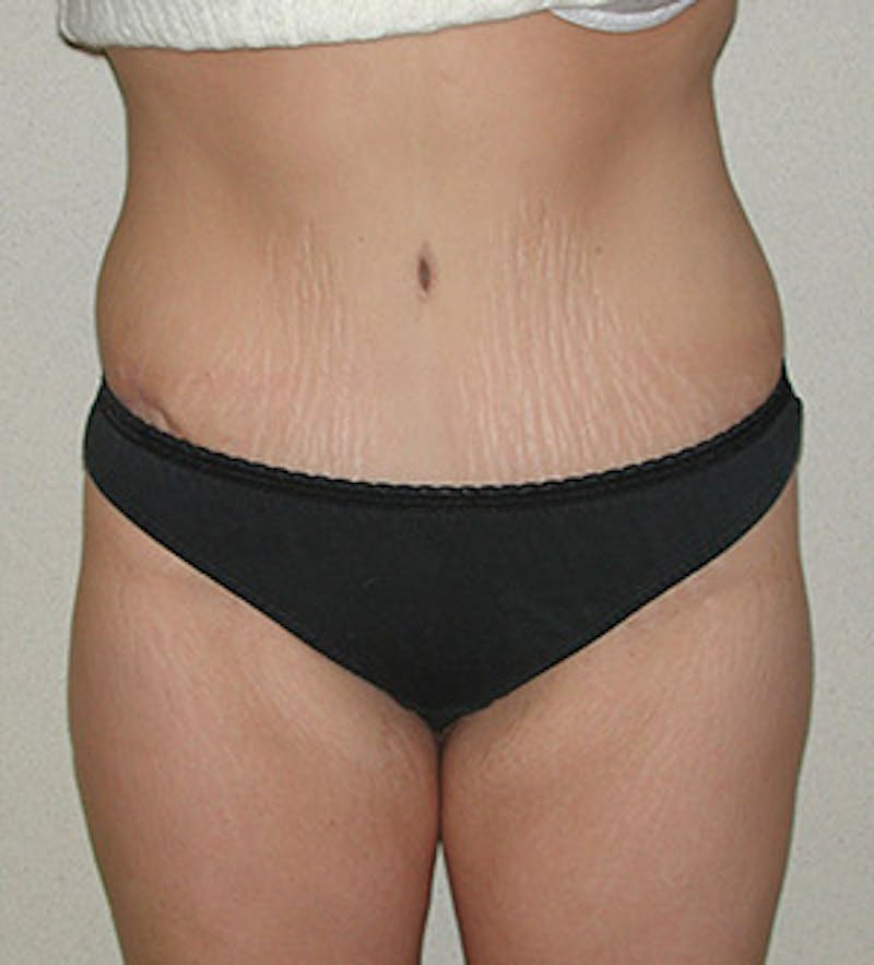 Tummy Tuck Before & After Gallery - Patient 122054813 - Image 2