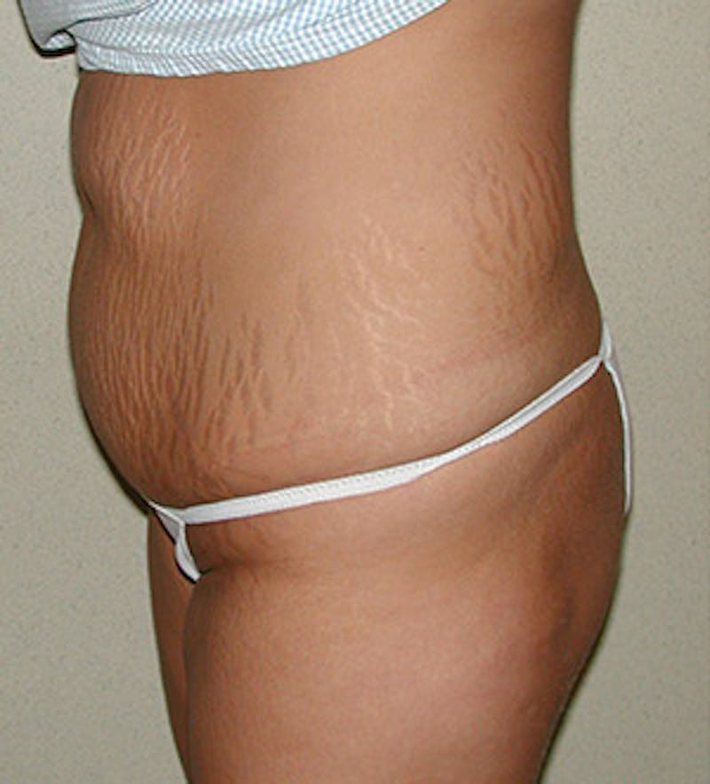 Tummy Tuck Before & After Gallery - Patient 122054813 - Image 3