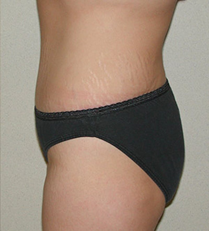 Tummy Tuck Before & After Gallery - Patient 122054813 - Image 4