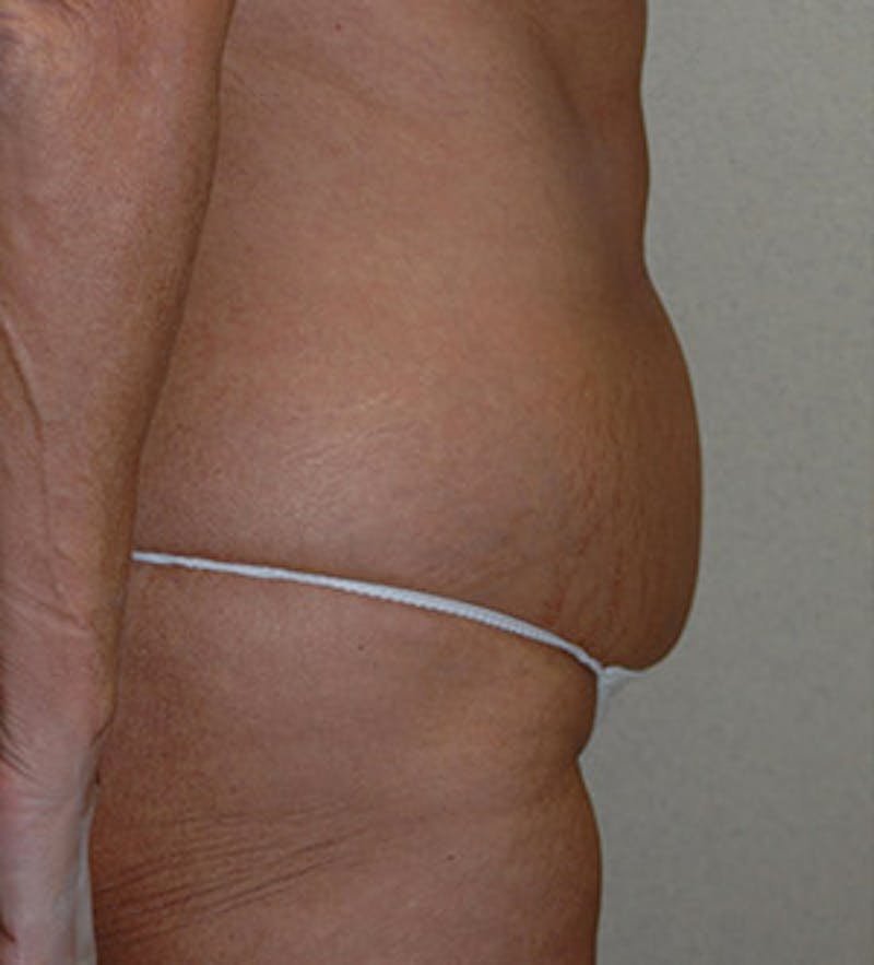 Tummy Tuck Before & After Gallery - Patient 122054815 - Image 3