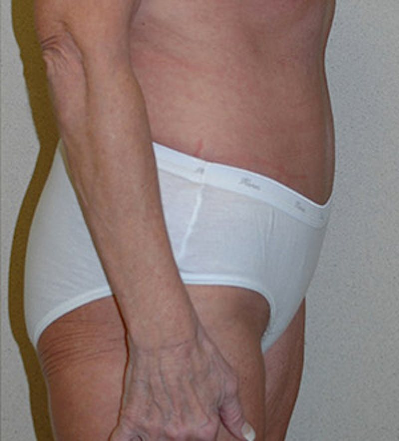 Tummy Tuck Before & After Gallery - Patient 122054815 - Image 4