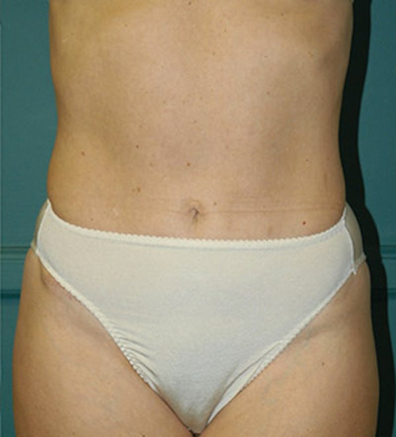 Tummy Tuck Before & After Gallery - Patient 122054816 - Image 2
