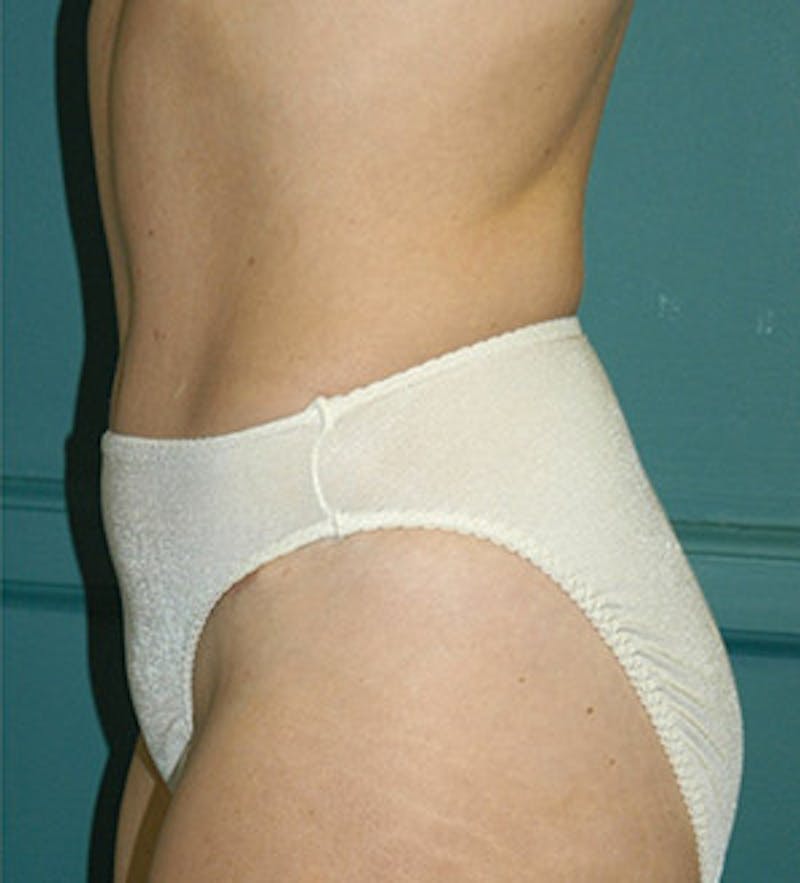 Tummy Tuck Before & After Gallery - Patient 122054816 - Image 4