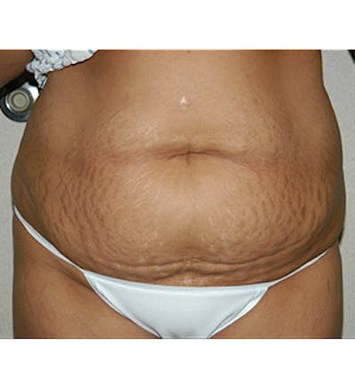 Tummy Tuck Before & After Gallery - Patient 122054818 - Image 1