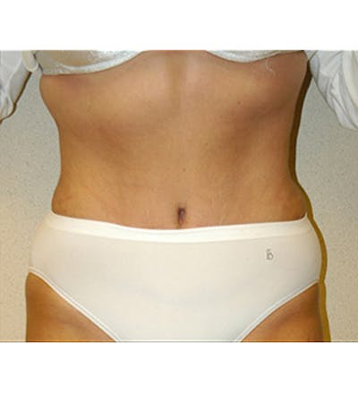 Tummy Tuck Before & After Gallery - Patient 122054818 - Image 2