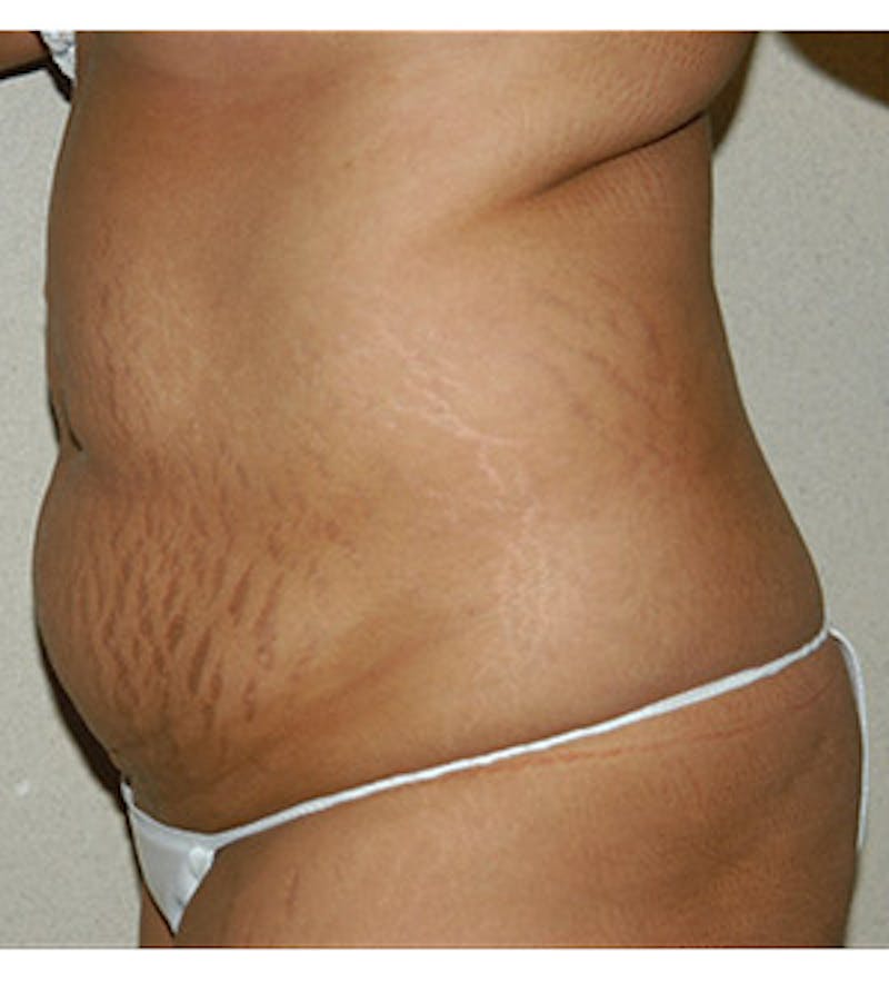 Tummy Tuck Before & After Gallery - Patient 122054818 - Image 3
