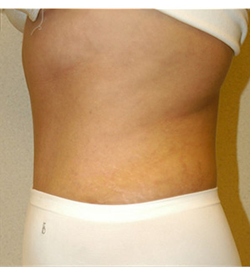 Tummy Tuck Before & After Gallery - Patient 122054818 - Image 4