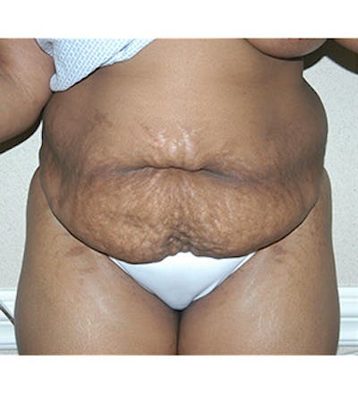 Tummy Tuck Before & After Gallery - Patient 122054819 - Image 1