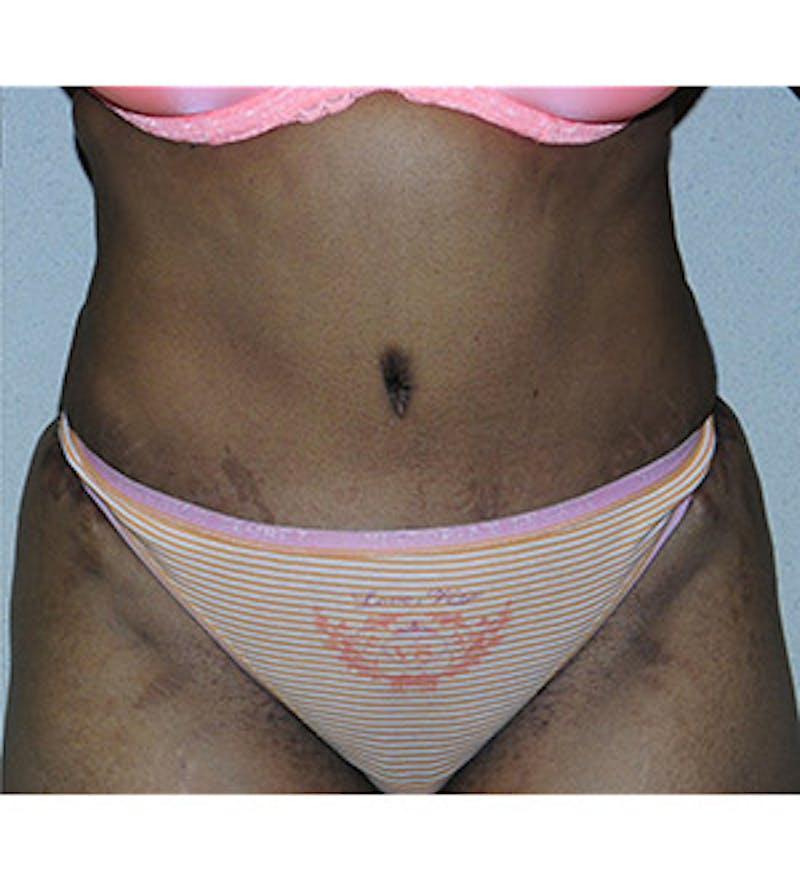 Tummy Tuck Before & After Gallery - Patient 122054819 - Image 2
