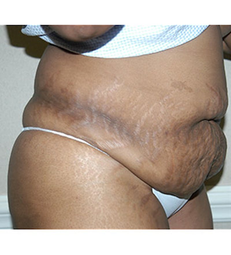 Tummy Tuck Before & After Gallery - Patient 122054819 - Image 3
