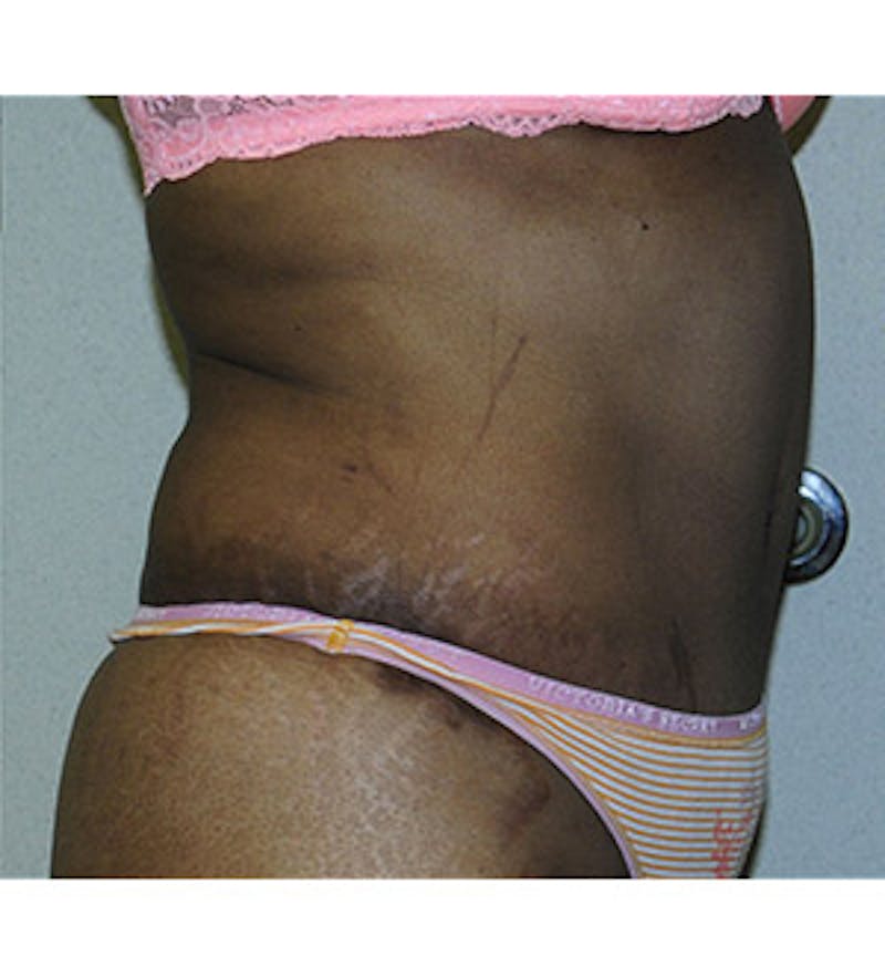 Tummy Tuck Before & After Gallery - Patient 122054819 - Image 4