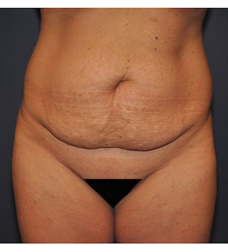 Tummy Tuck Before & After Gallery - Patient 122054820 - Image 1