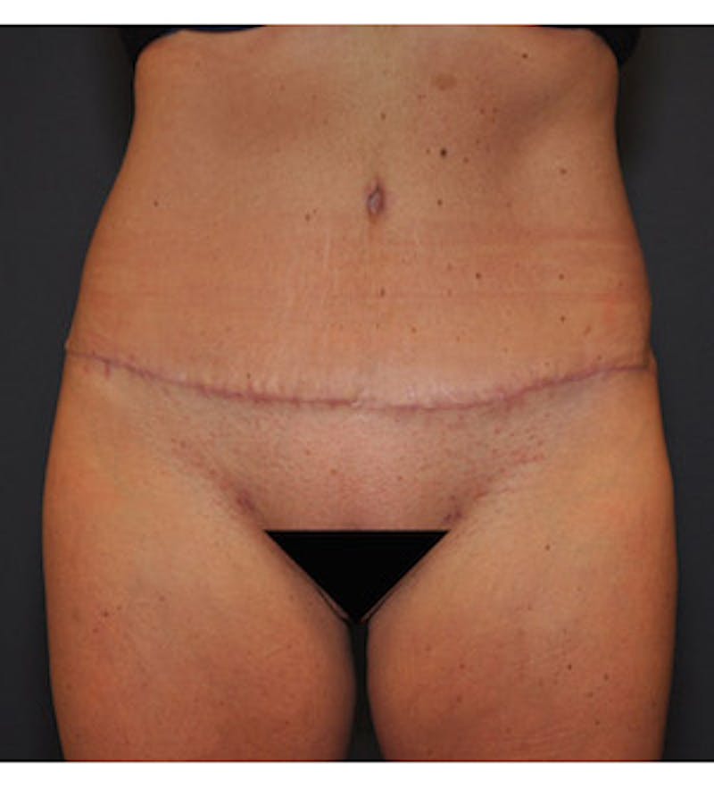 Tummy Tuck Before & After Gallery - Patient 122054820 - Image 2