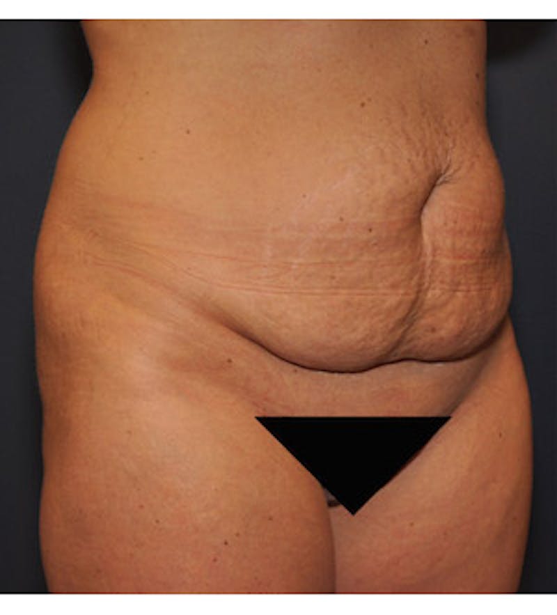 Tummy Tuck Before & After Gallery - Patient 122054820 - Image 3