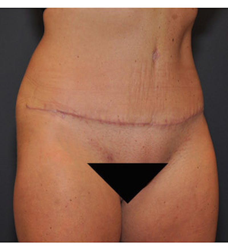 Tummy Tuck Before & After Gallery - Patient 122054820 - Image 4