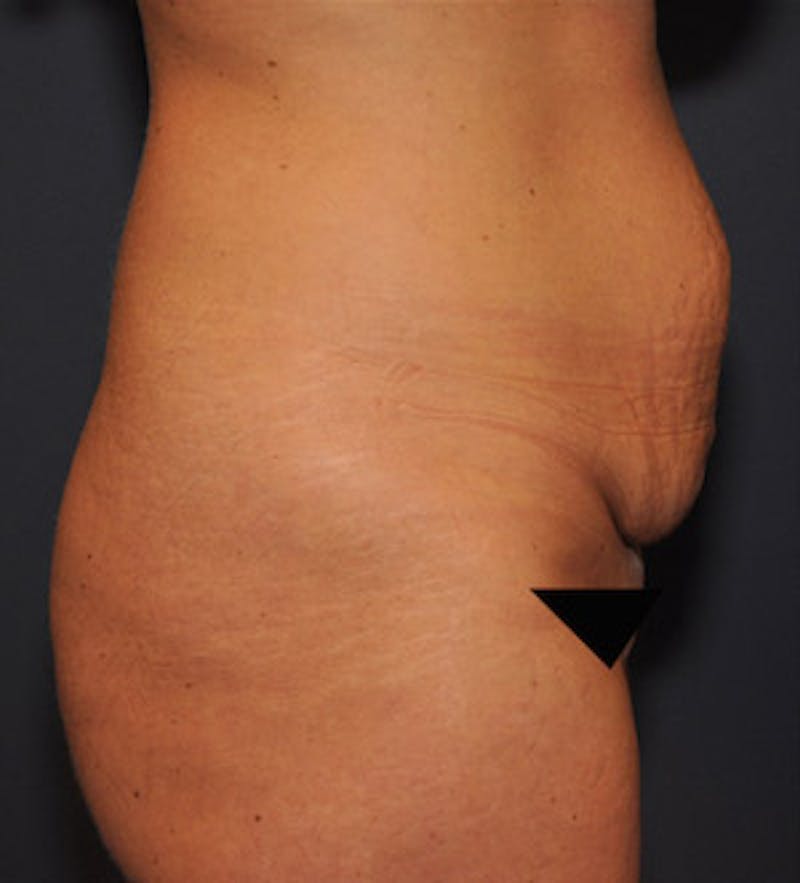 Tummy Tuck Before & After Gallery - Patient 122054820 - Image 5