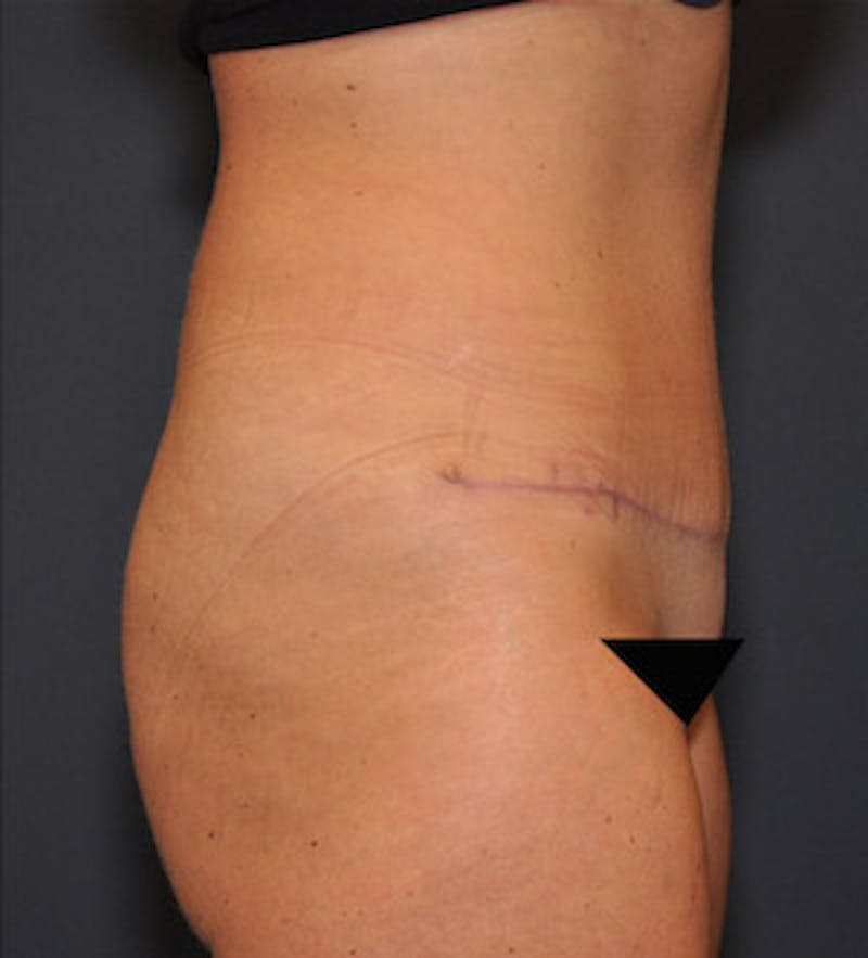 Tummy Tuck Before & After Gallery - Patient 122054820 - Image 6