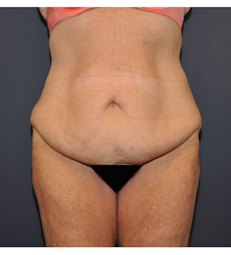 Tummy Tuck Before & After Gallery - Patient 122054828 - Image 1