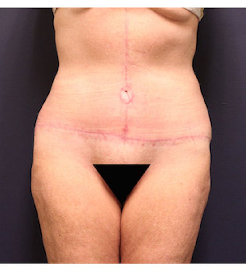 Tummy Tuck Before & After Gallery - Patient 122054828 - Image 2