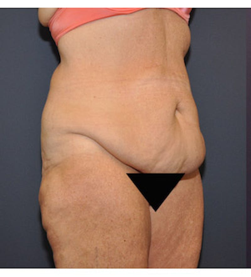 Tummy Tuck Before & After Gallery - Patient 122054828 - Image 3