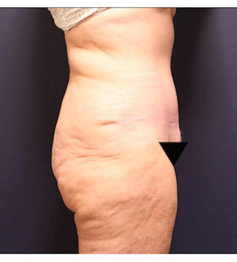 Tummy Tuck Before & After Gallery - Patient 122054828 - Image 6