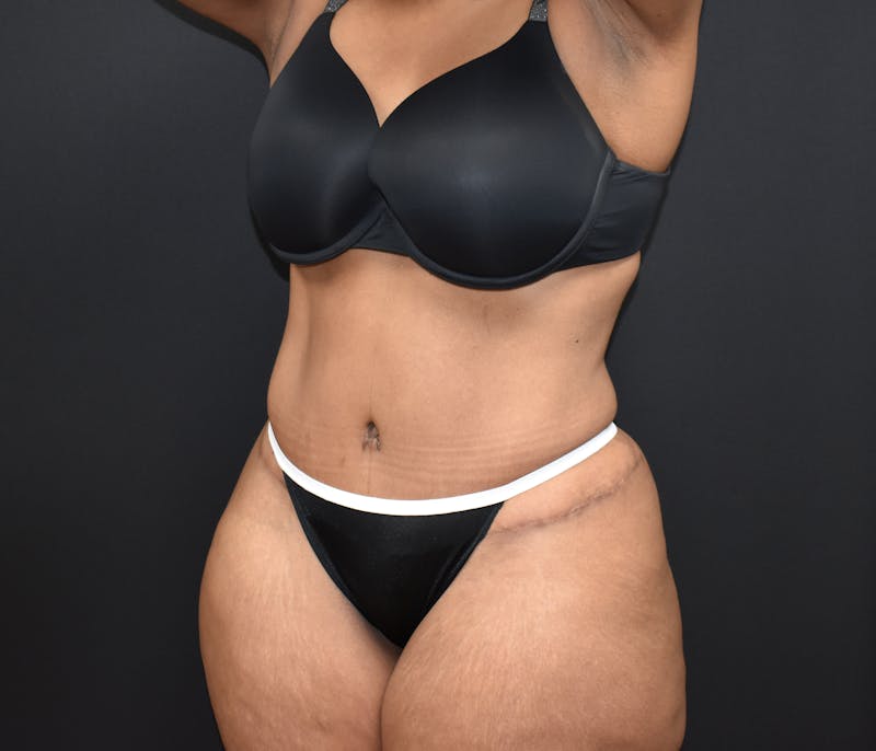 Tummy Tuck Before & After Gallery - Patient 123862151 - Image 6