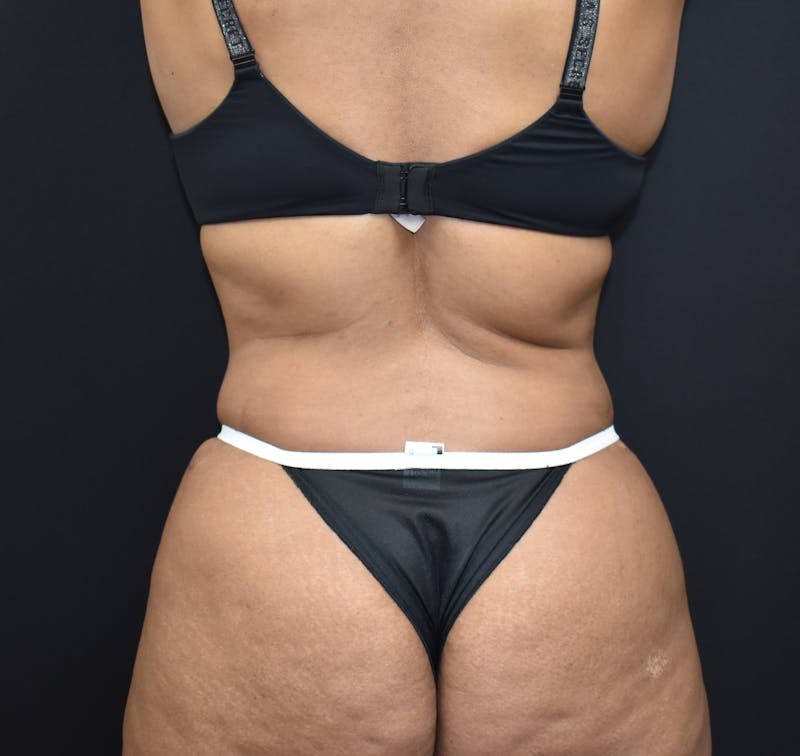 Tummy Tuck Gallery - Patient 123862151 - Image 8