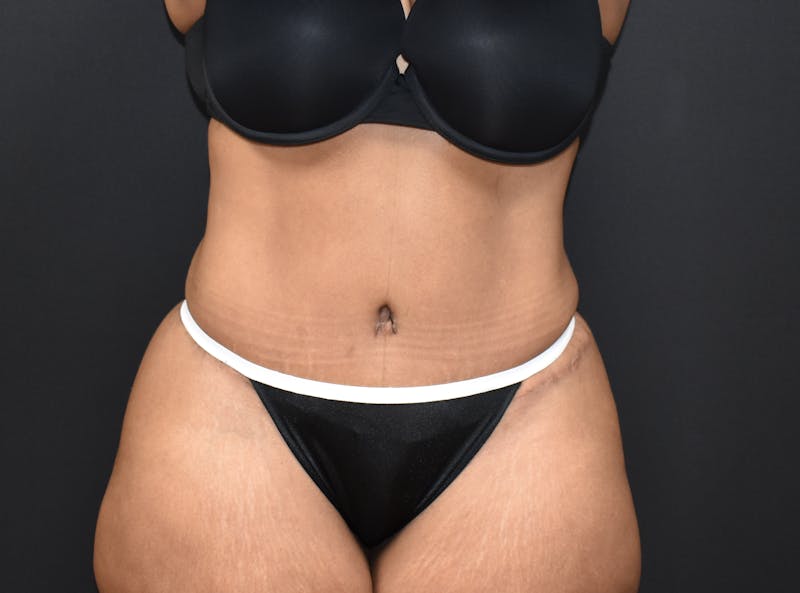 Tummy Tuck Gallery - Patient 123862151 - Image 2