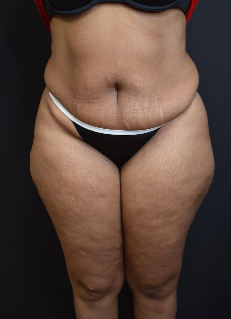 Tummy Tuck Before & After Gallery - Patient 123862151 - Image 1