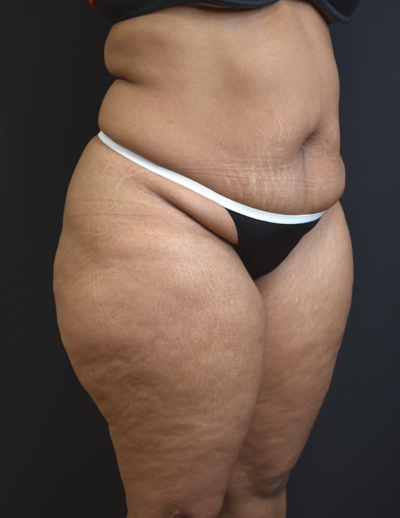 Tummy Tuck Before & After Gallery - Patient 123862151 - Image 3