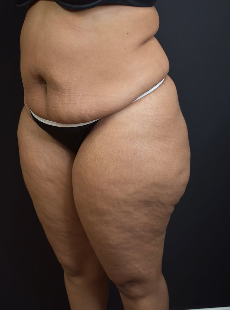 Tummy Tuck Before & After Gallery - Patient 123862151 - Image 5