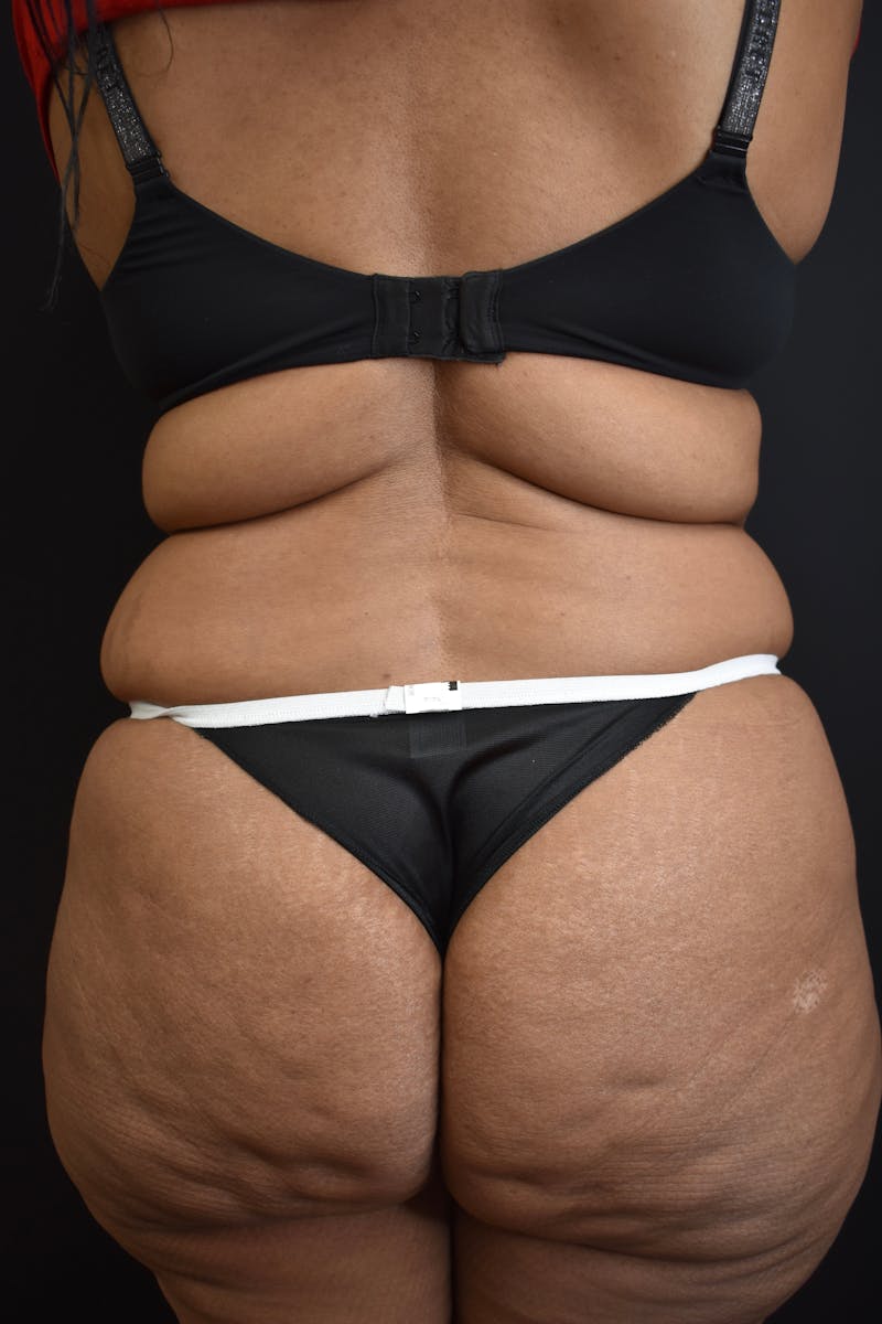 Tummy Tuck Before & After Gallery - Patient 123862151 - Image 7
