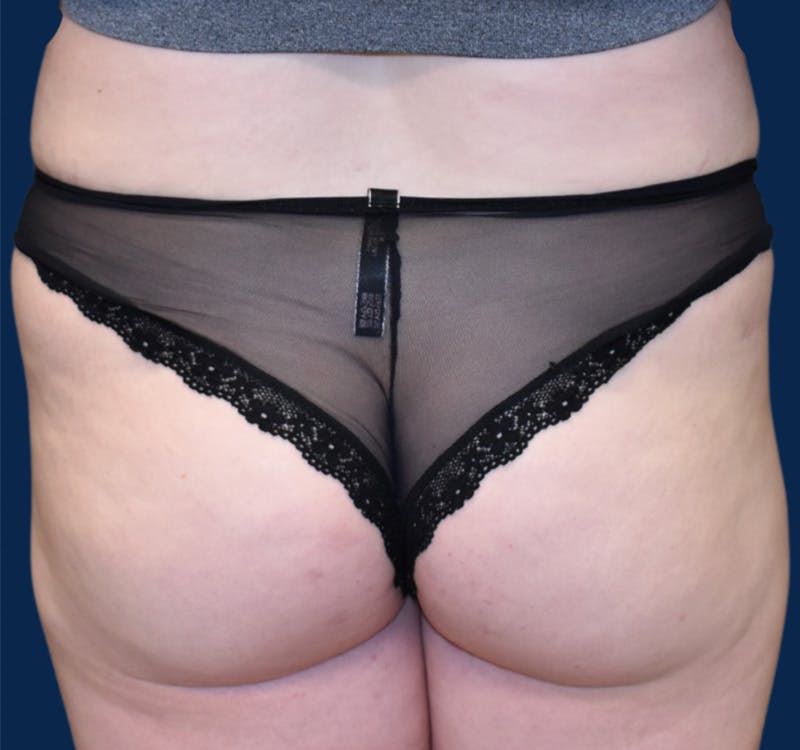 Brazilian Butt Lift Before & After Gallery - Patient 149148535 - Image 1
