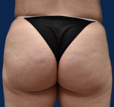 Brazilian Butt Lift Before & After Gallery - Patient 149148535 - Image 2