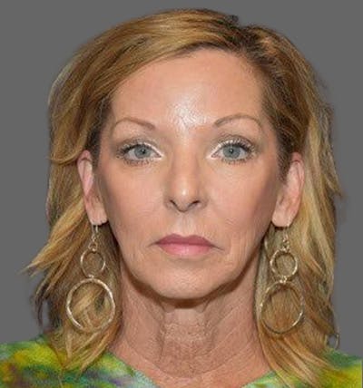 Facelift Before & After Gallery - Patient 122054789 - Image 1