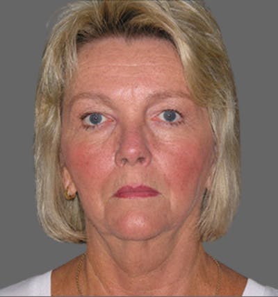 Facelift Before & After Gallery - Patient 122054790 - Image 1