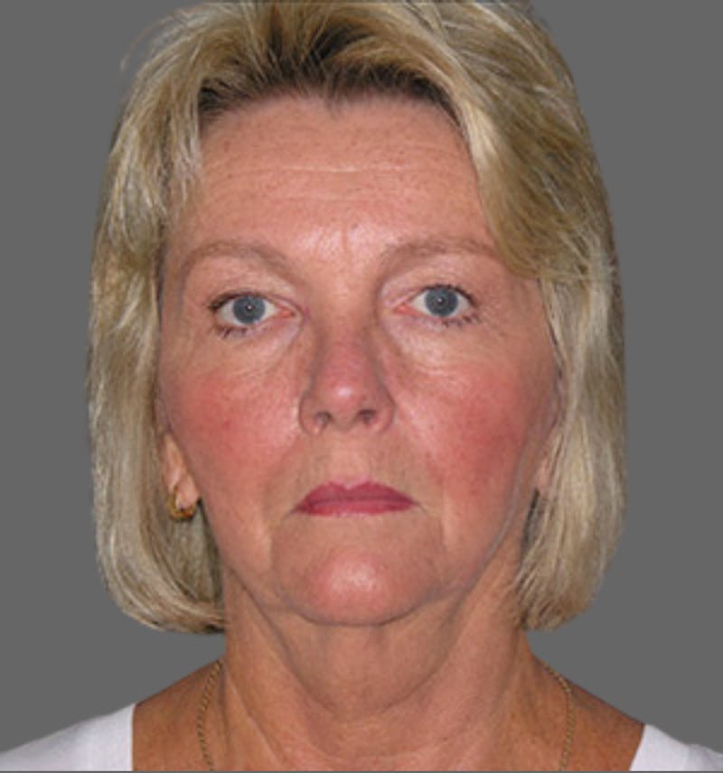 Facelift Before & After Gallery - Patient 122054790 - Image 1