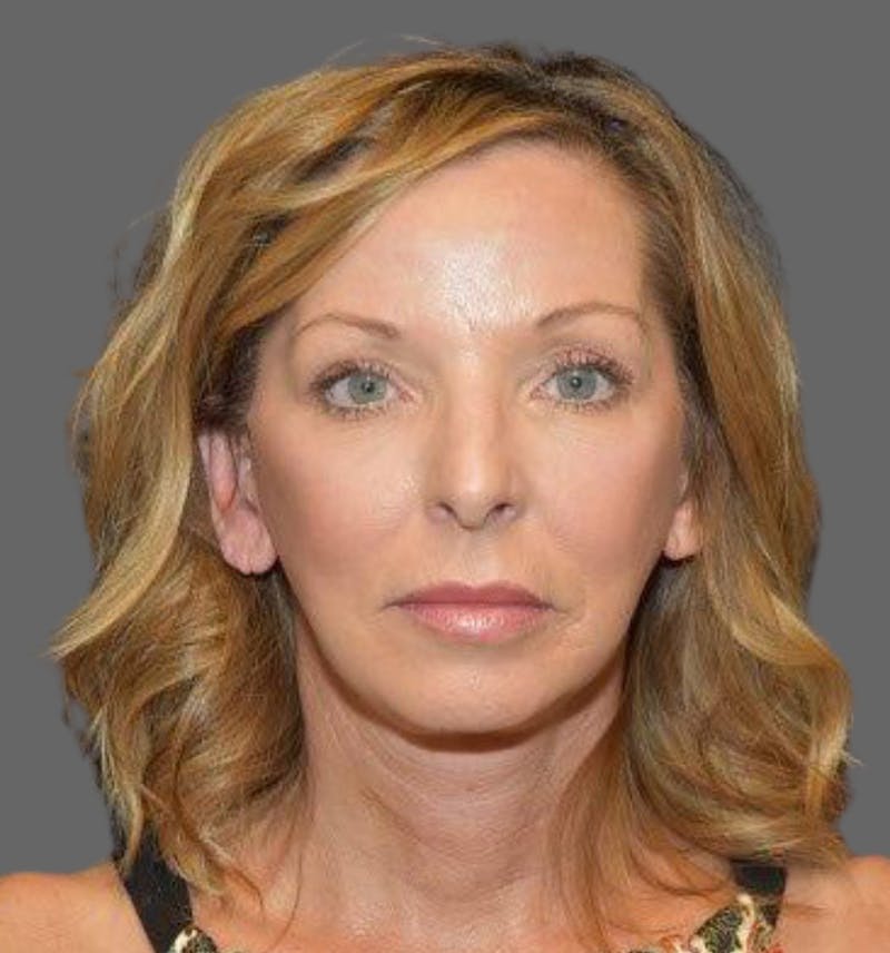Facelift Before & After Gallery - Patient 122054789 - Image 2