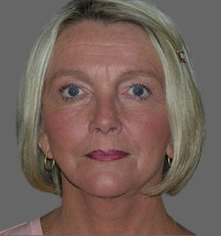 Facelift Before & After Gallery - Patient 122054790 - Image 2