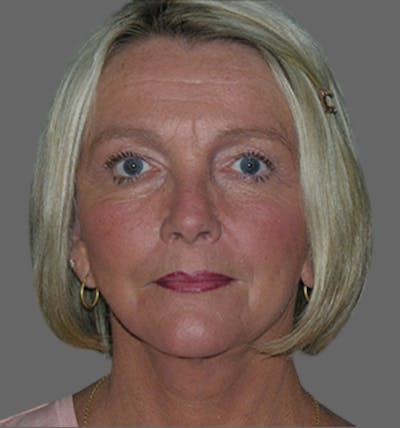 Facelift Before & After Gallery - Patient 122054790 - Image 2