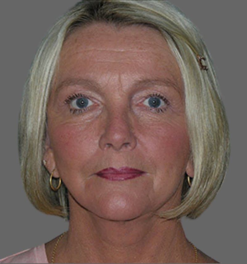 Facelift Before & After Gallery - Patient 122054790 - Image 2