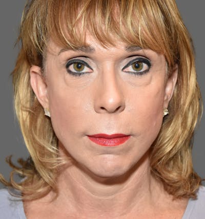Facelift Before & After Gallery - Patient 752702 - Image 1