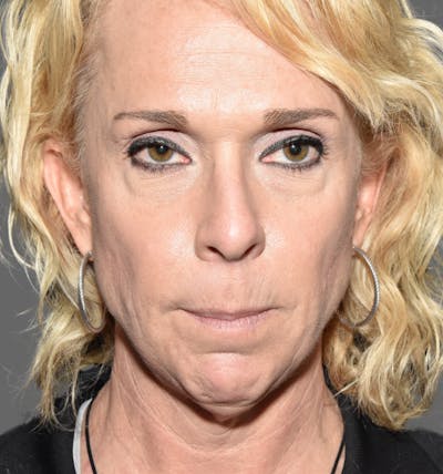 Facelift Before & After Gallery - Patient 752702 - Image 2