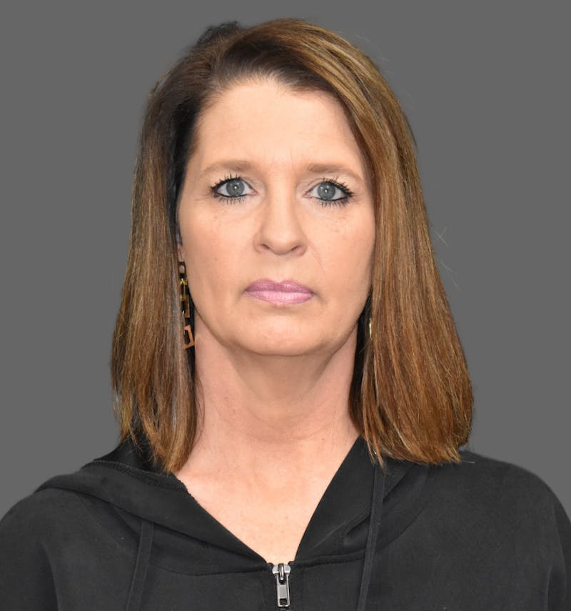 Facelift Before & After Gallery - Patient 374160 - Image 1