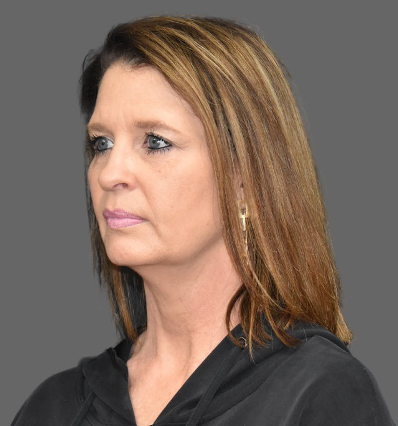 Facelift Before & After Gallery - Patient 374160 - Image 3